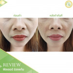 ฟิลเลอร์ร่องแก้ม เชียงราย - บริษัท ชิค คลินิก จำกัด 