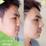 เสริมจมูก ผู้ชาย - บริษัท ชิค คลินิก จำกัด 