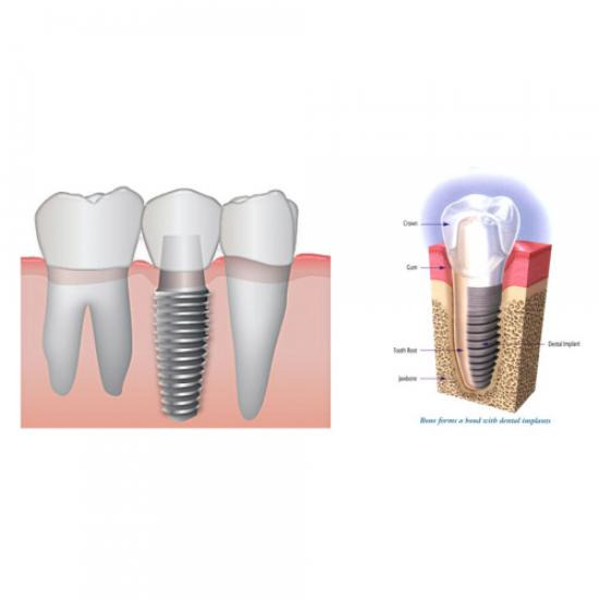 รักษารากฟัน เชียงใหม่  